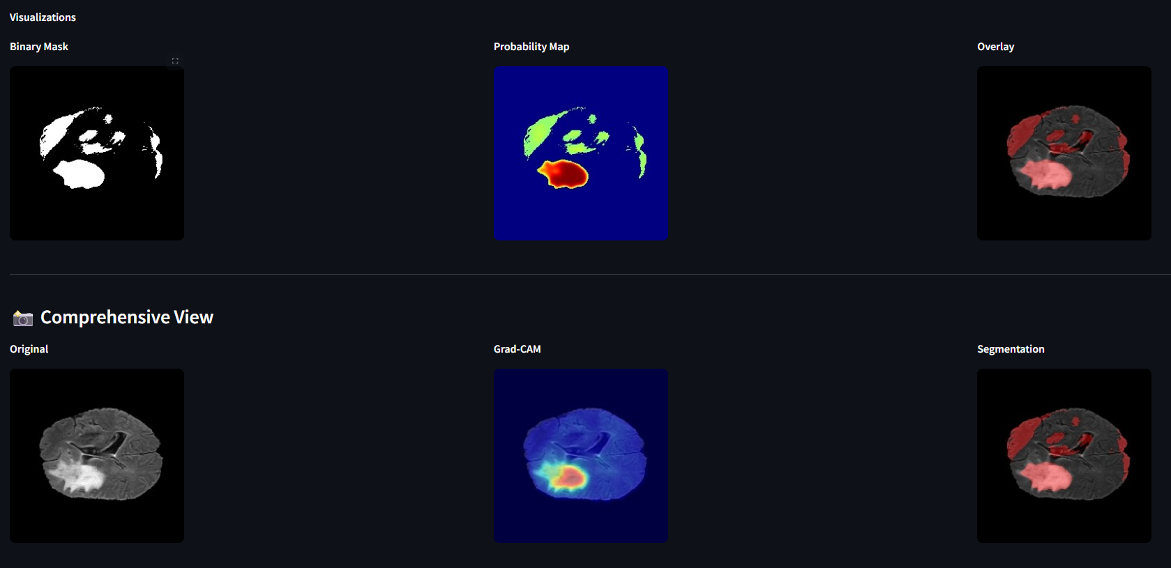Comprehensive view in SliceWise app showing Binary Mask, Probability Map, Overlay, Grad-CAM heatmap, and Segmentation output
