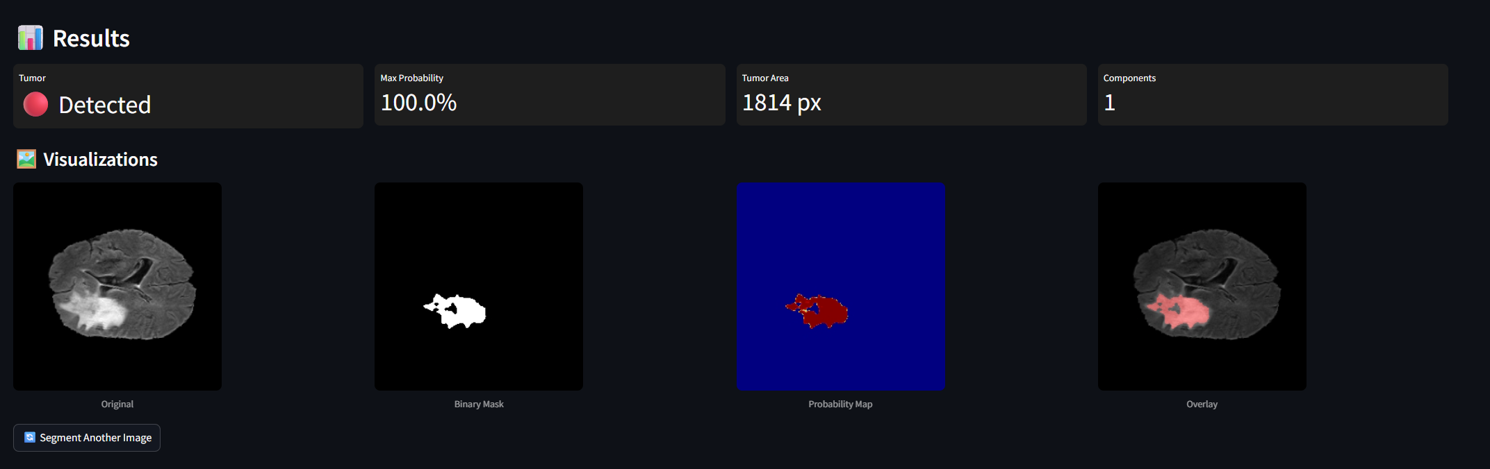 SliceWise app showing tumor Detected at 100% probability with Original, Binary Mask, Probability Map, and Overlay panels