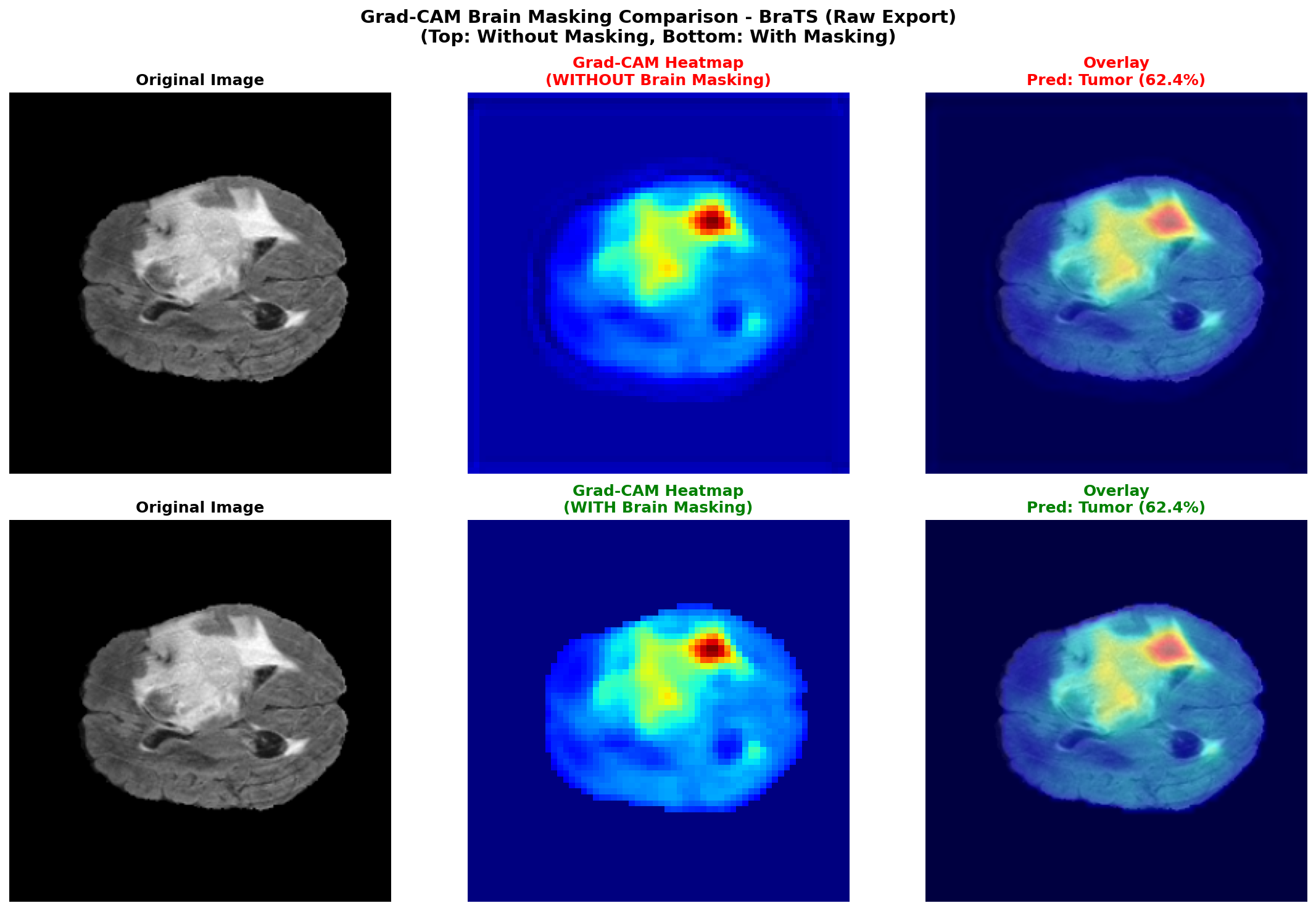 Grad-CAM brain masking comparison on BraTS dataset — masking sharpens heatmap focus on tumor sub-regions