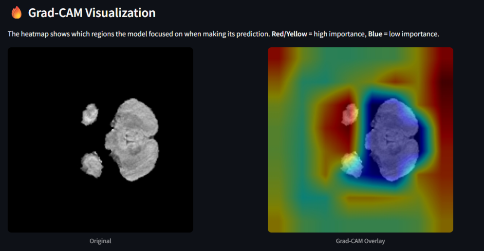 Grad-CAM masking comparison on Kaggle showing inaccuracy when intercrossing datasets — attention leaks outside brain boundary