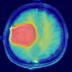 SliceWise Grad-CAM UI showing original MRI slice alongside the Grad-CAM heatmap overlay