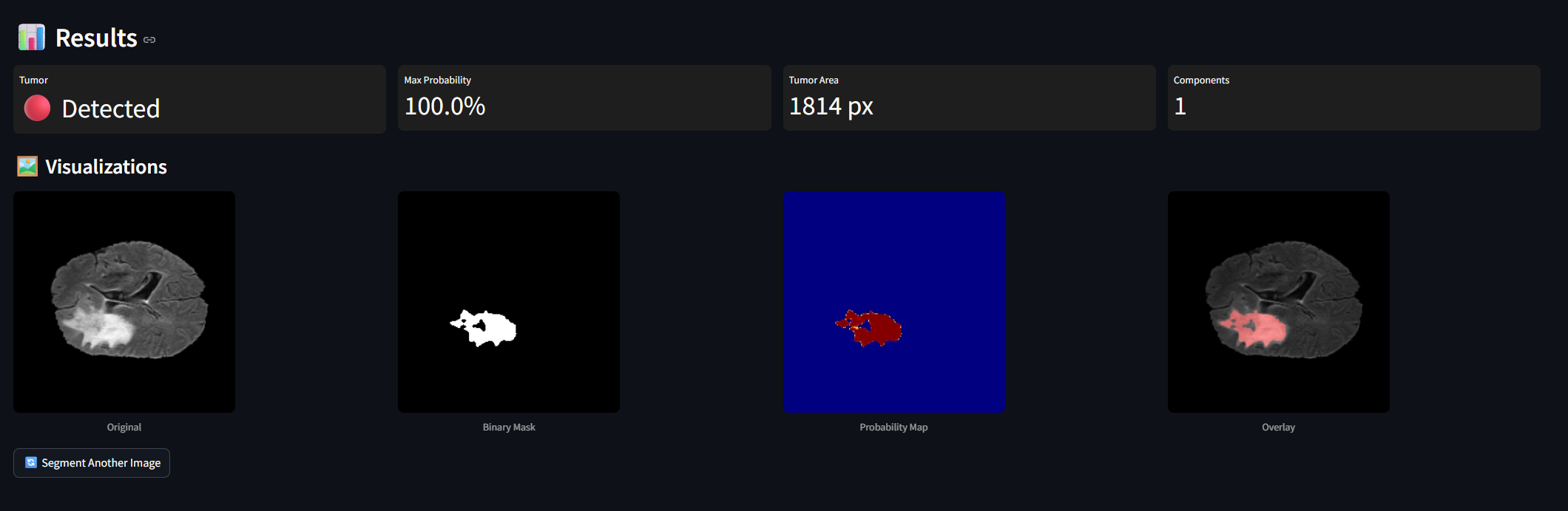 Close-up Grad-CAM heatmap showing high-intensity red region precisely over the tumor mass