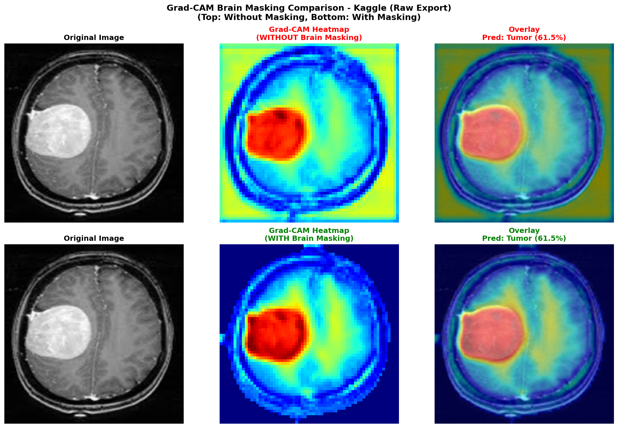 Grad-CAM brain masking comparison on Kaggle dataset — top row without masking, bottom row with masking applied
